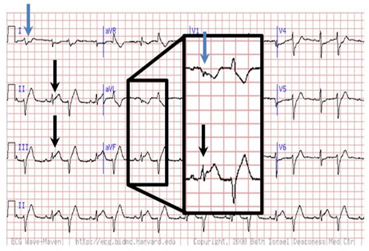 are-you-missing-subtle-mi-clues-on-ecgs-test-your-skills