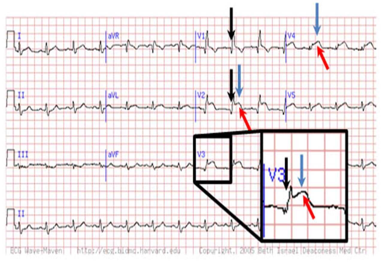 septal-infarct-age-undetermined