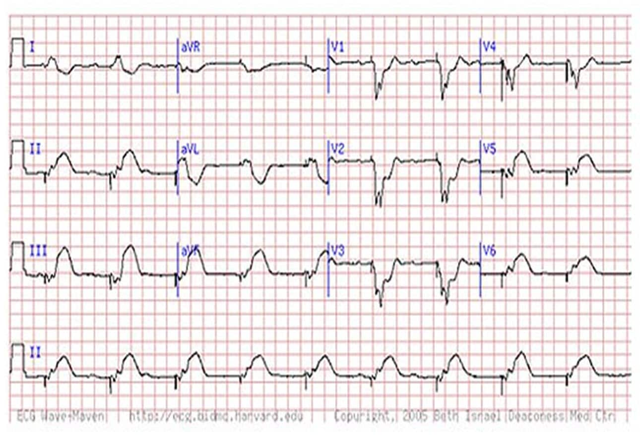 Inferior Myocardial Infarction Of Indeterminate Age