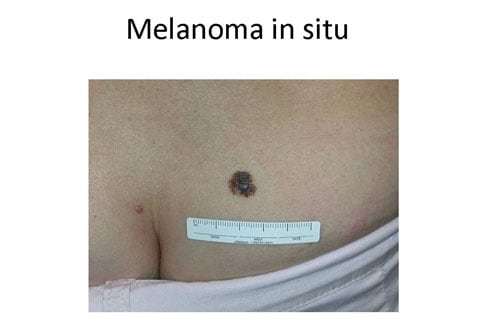Mole or Melanoma? Tell-Tale Signs in Benign Nevi and Malignant