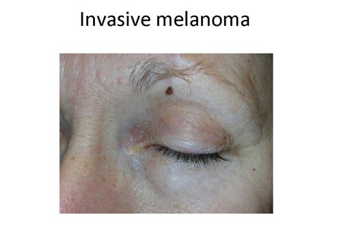 melanoma inside nose