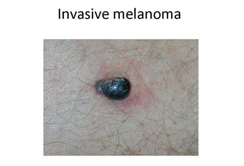 Melanoma Ulceration