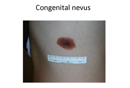 benign nevus