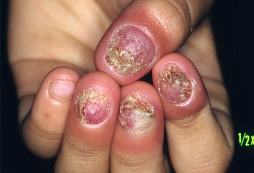 Fungal nail infection: MedlinePlus Medical Encyclopedia