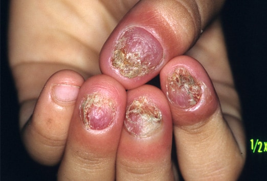 Fingernail Diseases Pictures