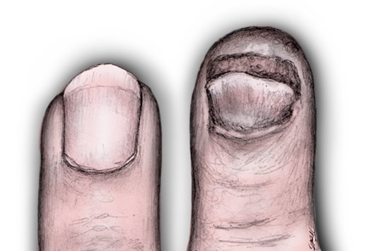 prying off and to allow for normal replacement of nail growth