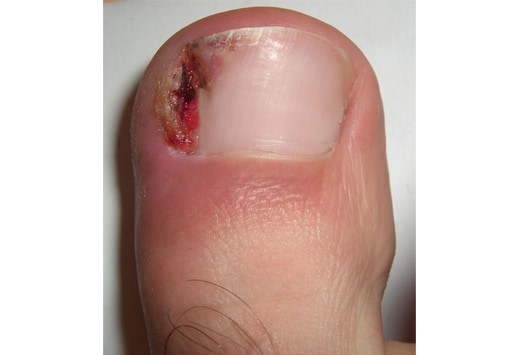 Fingernail Diseases Pictures