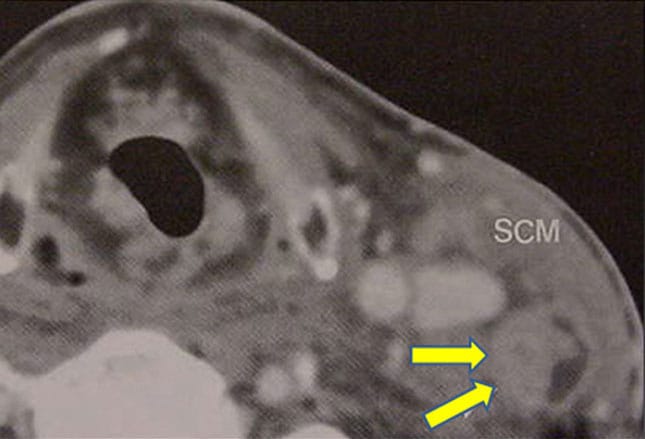 Male Hpv Mild