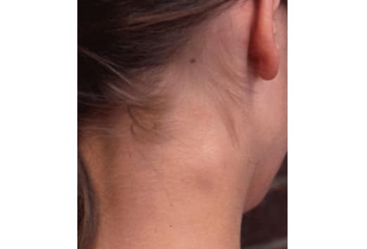 swollen occipital lymph nodes