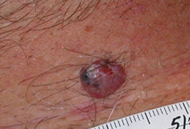 small skin ulcers