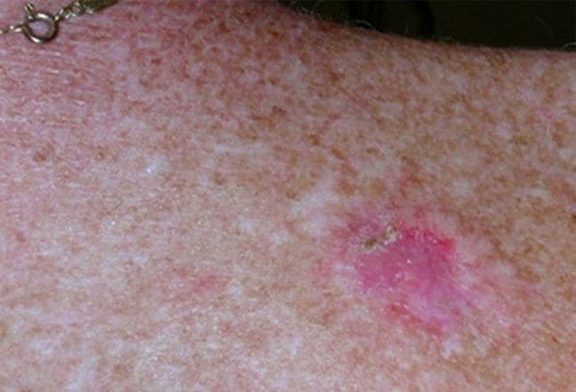 pearly pink papules. scaly patch or papule that