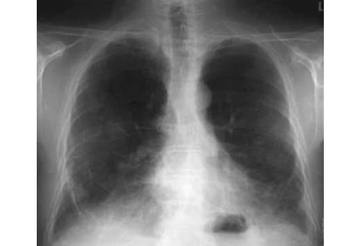 Mica pneumoconiosis: a neglected occupational lung disease - The Lancet  Respiratory Medicine