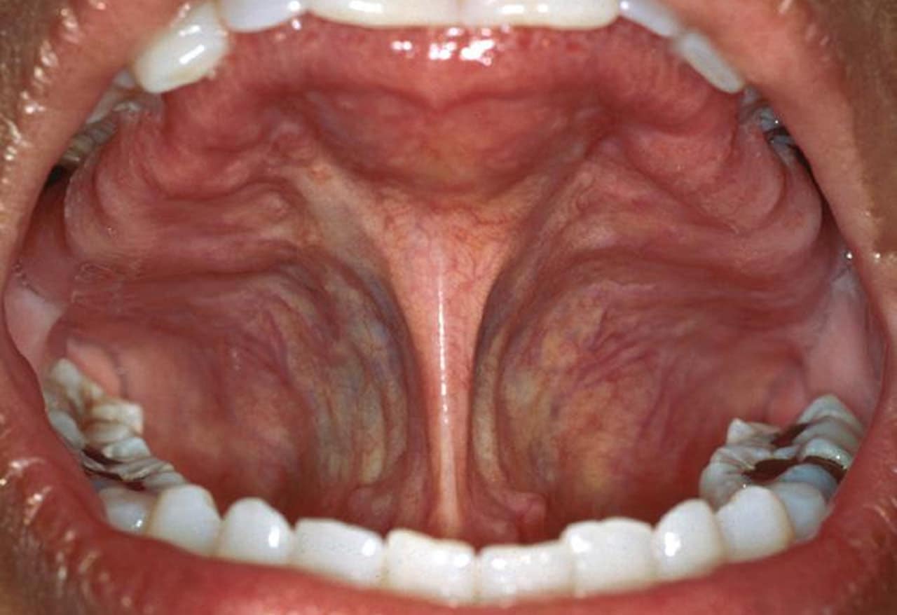 cavity between molars