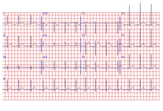 Normal Ekg Strip