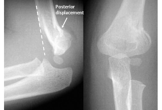 Fractures in children Adults バーゲン www.laboratoriogenoma.eu