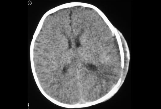 skull fracture long term effects