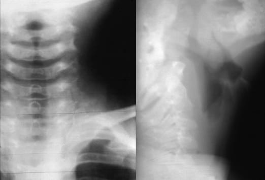 infectious bronchitis signs and symptoms in fowl