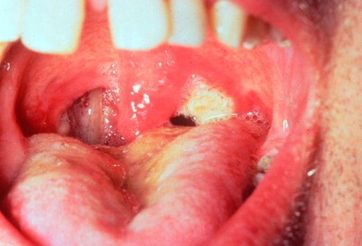 Throat Lesion 113