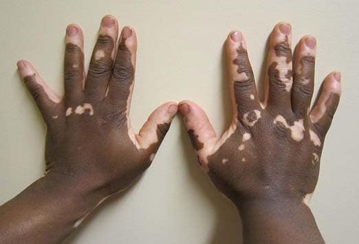 Common Pigmentation Disorders - American Family Physician