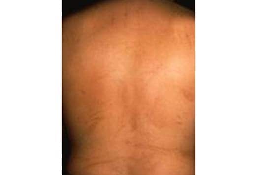 Skin Discoloration On Arms