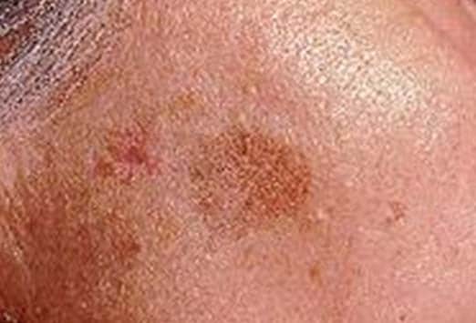 Scaly Patch Of Skin On Scalp