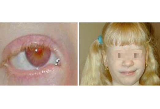 Disorders Of Pigmentation Slideshow