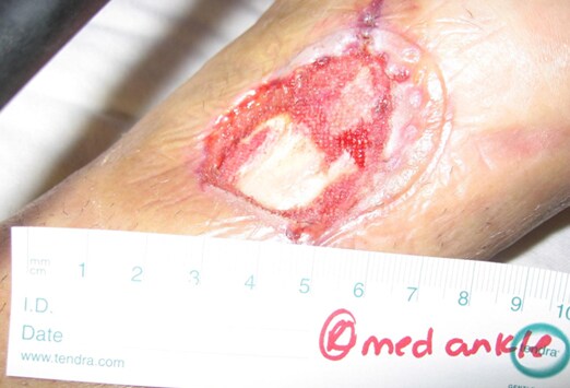 Epithelial Wound