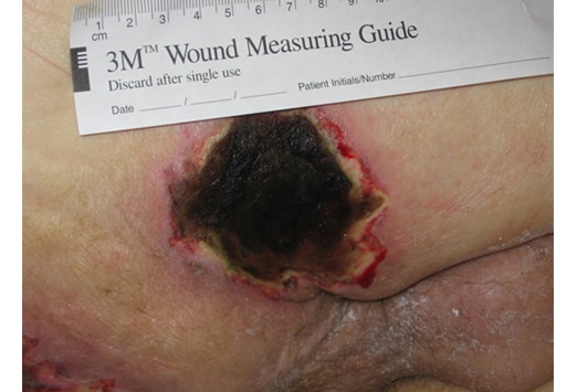 Wound Undermining