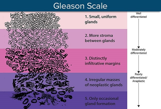 Prostate Cancer Diagnosis and Staging