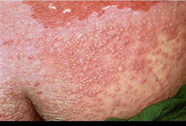 acute psoriasis