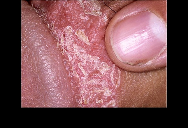 Shaving rash - Home - Embarrassing Problems