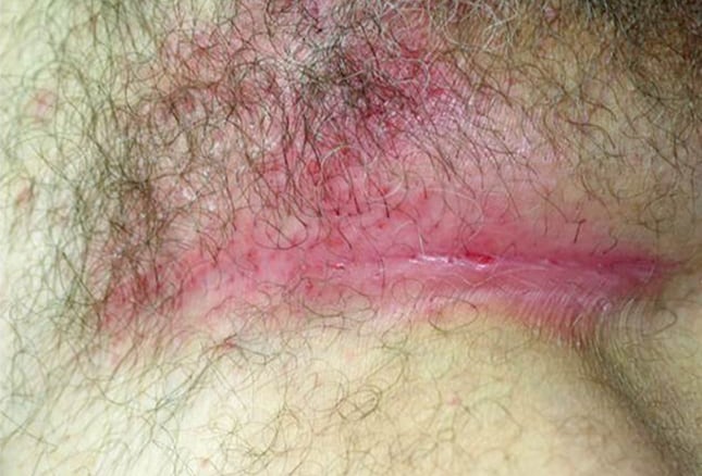 Itchy Skin Rash - Medical Pictures