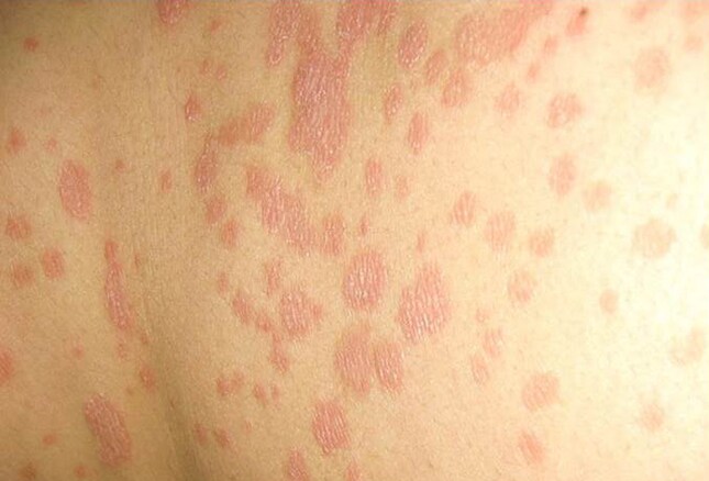 the-many-manifestations-of-psoriasis