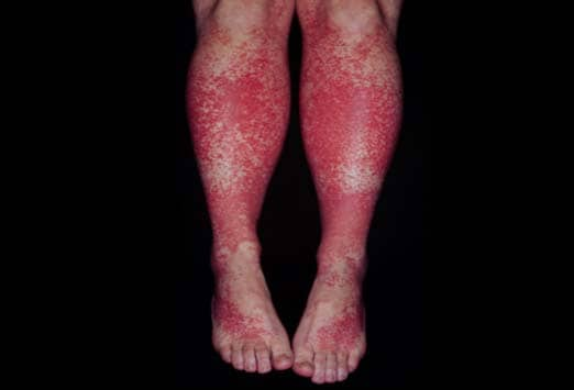 red rash on lower leg | Lifescript.com