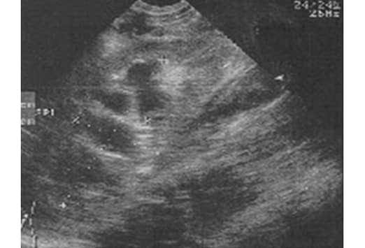 Suspect flank pain? Consider ultrasound for first-line imaging • APPLIED  RADIOLOGY