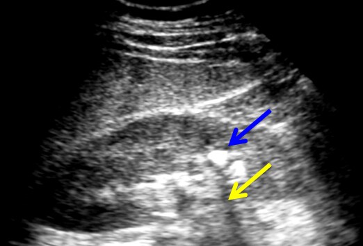 An Elusive Cause of Severe Recurrent Flank Pain: Case Quiz