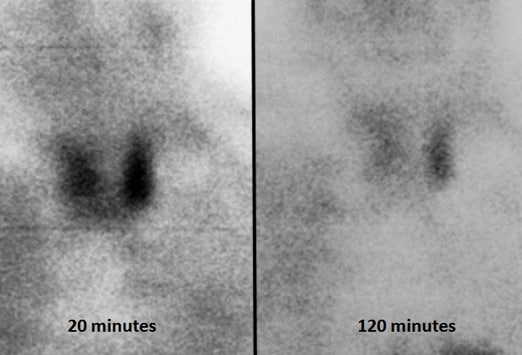 An Elusive Cause of Severe Recurrent Flank Pain: Case Quiz