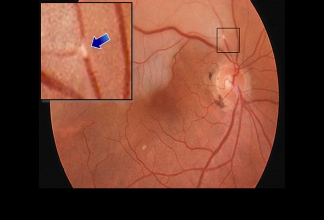 abnormal retinal scan abnormal retinal scan