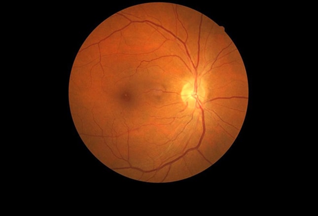 white spot in eye retina