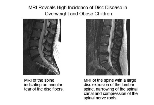 herniation of brain. quot;Disc herniation and spinal