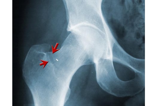 sore-lower-back-and-hip-right-side-hurts-common-hip-injuries-in