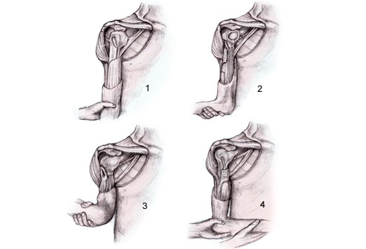 Shoulder Dislocation Reduction Technique Slideshow