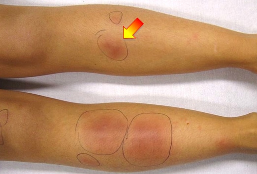 Skin and Subcutaneous Nodules information page | Patient