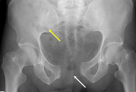 Grade 3 AP compression fracture of the pelvis