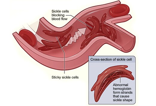 Sickle Rbc