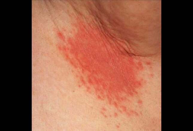 Home remedy of diabetes mellitus type
