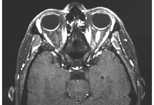 optic neuritis optic neuritis