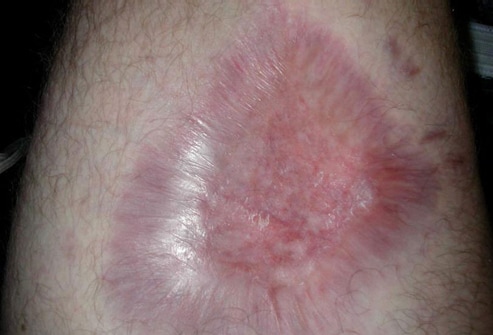 Brown Recluse Bites: Images, Symptoms, Treatment