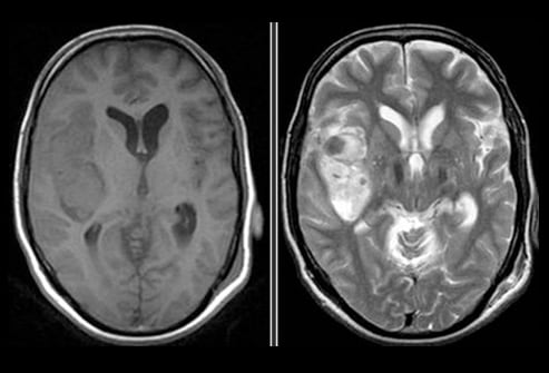 Hemorrhage On Mri