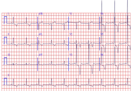 Ekg Ischemia